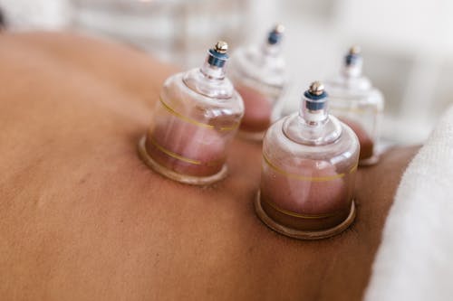 cupping massage therapie